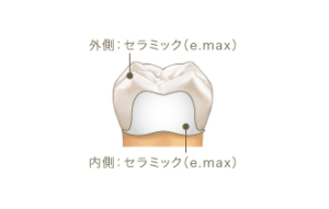 オールセラミッククラウン（e.maxセラミック）