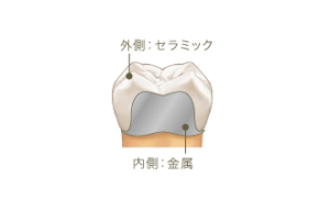 メタルボンドクラウン
