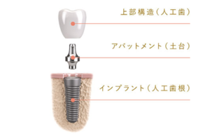 インプラント治療とは