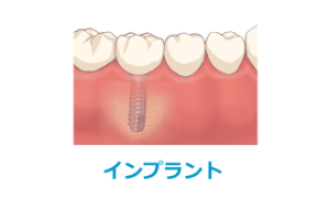 インプラント