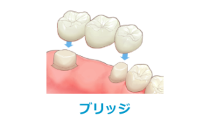 ブリッジ